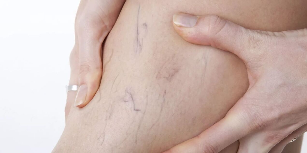 Antes de usar crema de varicón