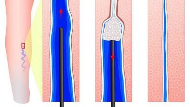 Escleroterapia en varices