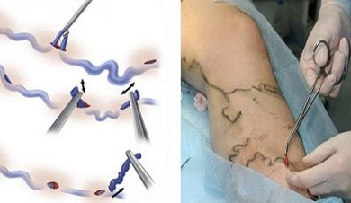 Flebectomía para varices nas pernas