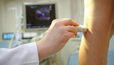 Tratamento con láser de varices